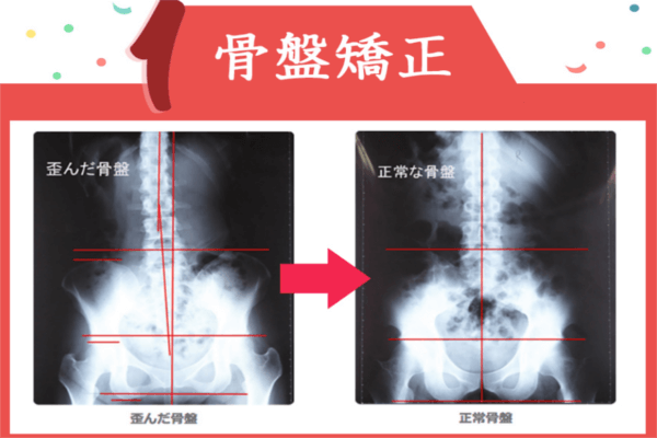 骨盤矯正効果