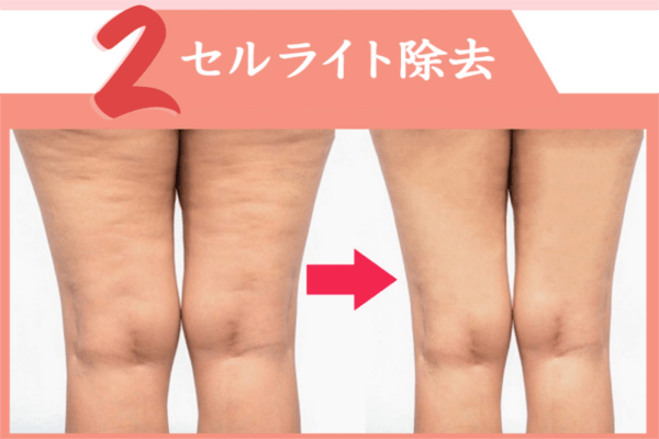 セルライト除去効果