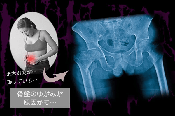 骨盤の歪み