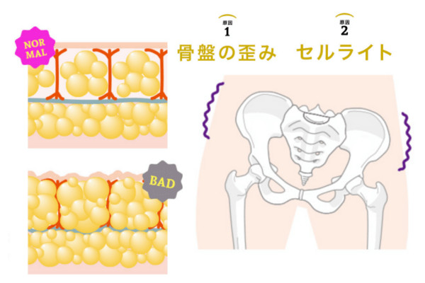 骨盤の歪みとセルライト